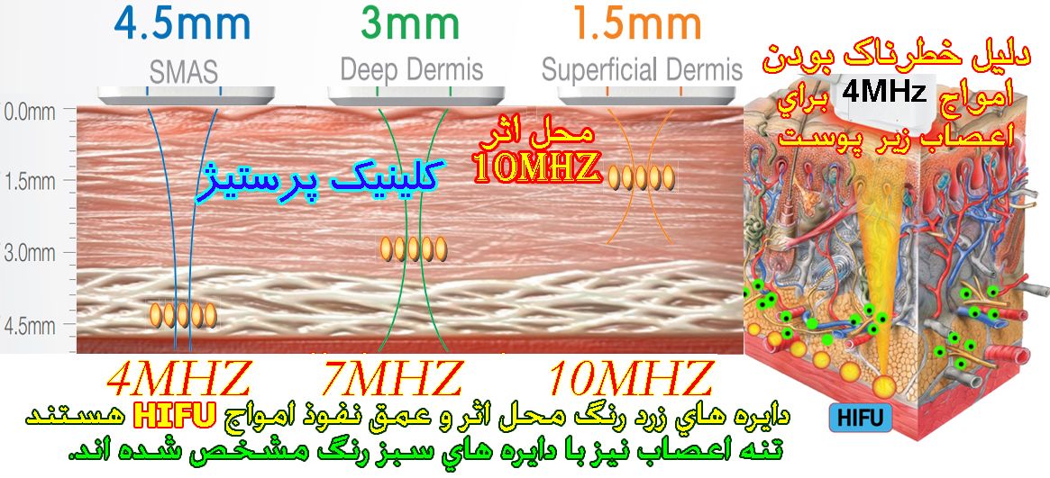 هایفوتراپی