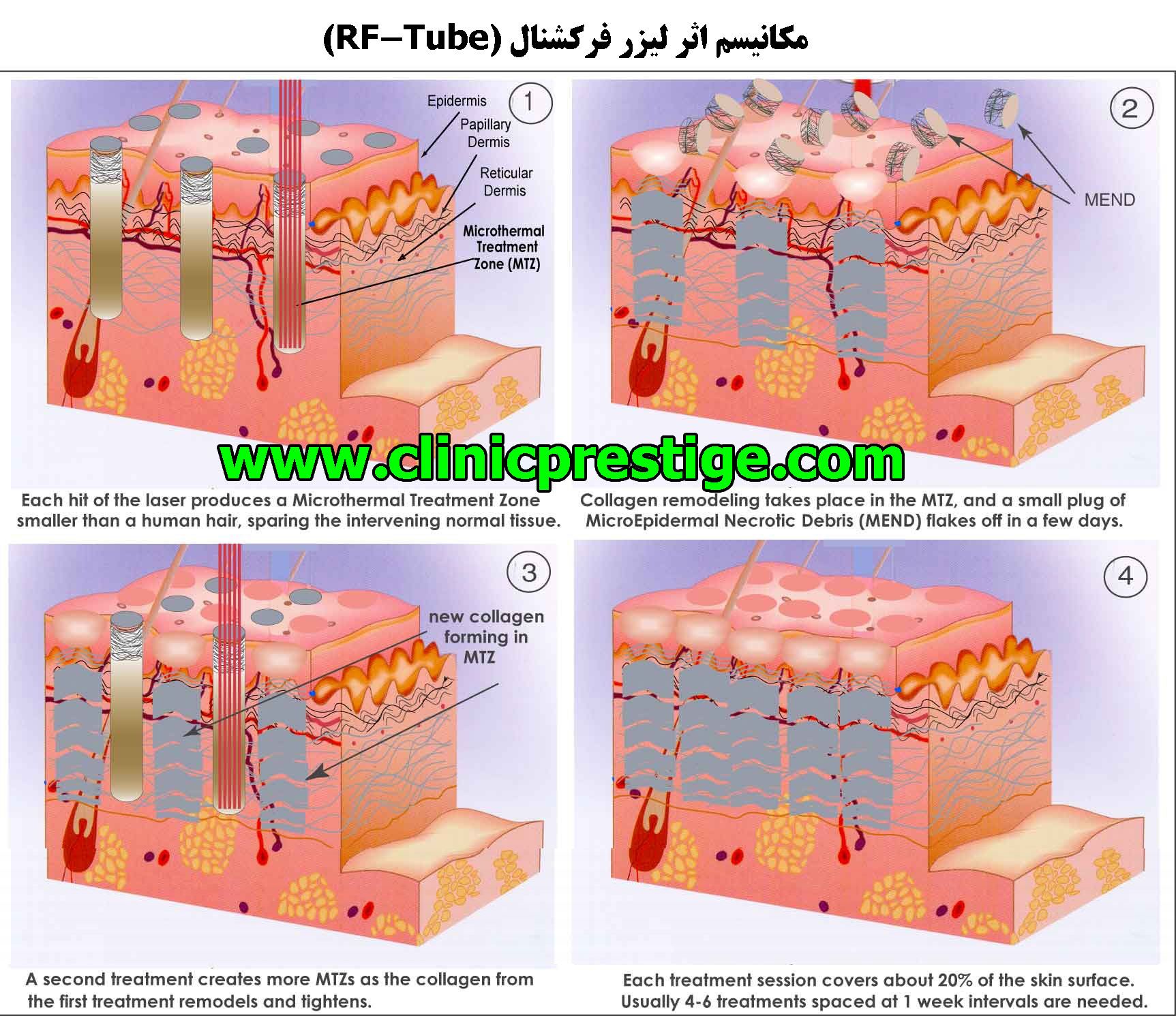 لیزر فرکشنال
