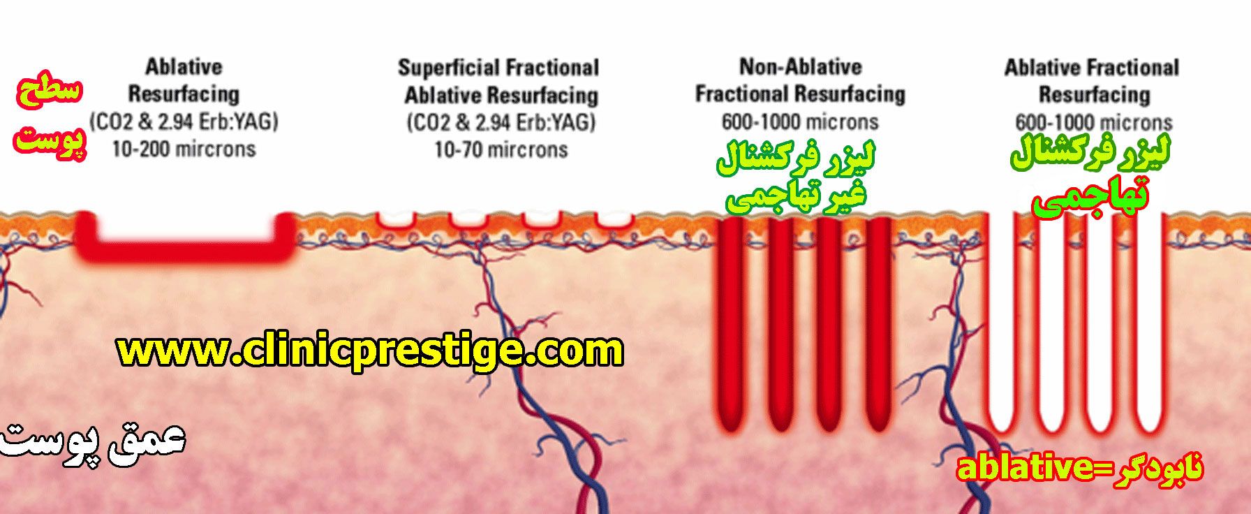  co2 لیزر فرکشنال 