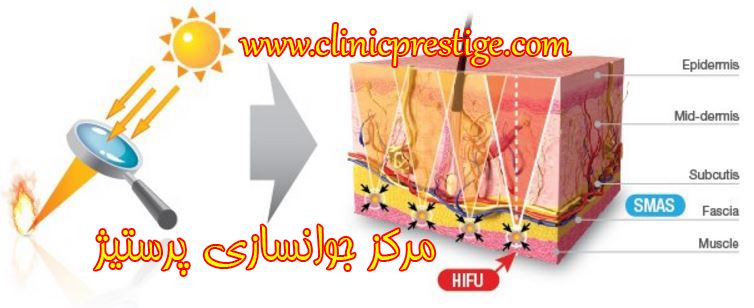 هایفوتراپی