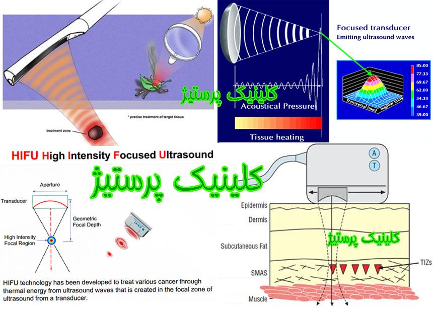 هایفوتراپی  دابلو